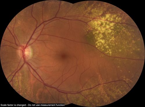 Choroidal Nevus with Drusen
Low risk choroidal nevus with many overlying drusen

