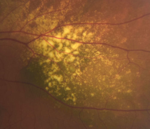 Choroidal Nevus with Drusen
Low risk choroidal nevus with many overlying drusen
