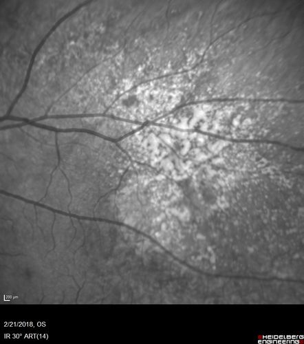 Choroidal Nevus with Drusen
Low risk choroidal nevus with many overlying drusen
