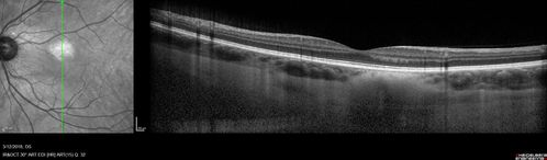 Choroidal Nevus - Macula - Flat
37 year old female with 5 year stable nevus Left eye - OCT shows flat nevus (EDI scan)
