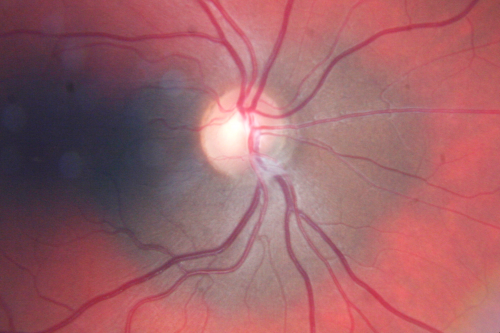Peripapillary Choroidal Nevus
37-year-old woman was seen in the office on July 27, 2011.  She has photographs from 2009 and 2010 showing a peripapillary choroidal nevus in the right eye.  VISUAL ACUITY:  OD 20/20
