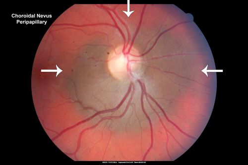 Peripapillary Choroidal Nevus
37-year-old woman was seen in the office on July 27, 2011.  She has photographs from 2009 and 2010 showing a peripapillary choroidal nevus in the right eye.  VISUAL ACUITY:  OD 20/20
