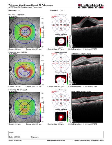 Central Serous Chorioretinopathy - Expanding hot spot - photodynamic laser
35 year old man with acute central serous chorioretinopathy.  The fluid got better then worse and the patient was treated with full strength juxtafoveal PDT and then got better.
