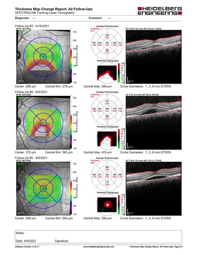 Central Serous Chorioretinopathy - Expanding hot spot - photodynamic laser
35 year old man with acute central serous chorioretinopathy.  The fluid got better then worse and the patient was treated with full strength juxtafoveal PDT and then got better.
