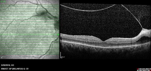 Non-central vitreomacular traction
