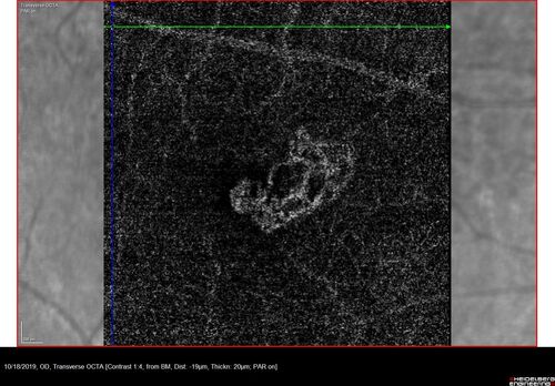 Non-exudative wet AMD - OCT angiogram
85 year old female with minimal visual complaints. 
VA OD: sc20/80+1 PHNI NccJ3
VA OS: sc20/40-2 PH20/32+1 NccJ3
IOP: TP: OD:14 OS:16
