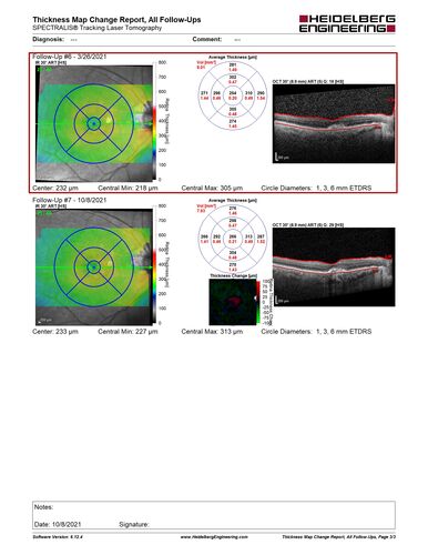 Non-exudative wet AMD - OCT angiogram
85 year old female with minimal visual complaints. 
VA OD: sc20/80+1 PHNI NccJ3
VA OS: sc20/40-2 PH20/32+1 NccJ3
IOP: TP: OD:14 OS:16
