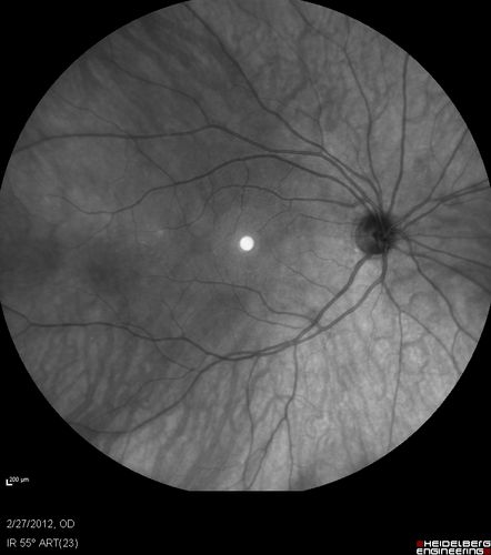 Normal Infrared Image
48-year-old woman has had a problem with light and dark adaptations.  She notices when she sees a point source of light like a cell phone in a dimly lit room and then she turns the cell phone off, that subsequently her vision is very dark until she goes back into a well lighted area.  OD 20/20,  OS 20/25. 

