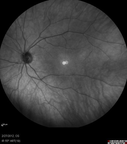 Normal Infrared Image
48-year-old woman has had a problem with light and dark adaptations.  She notices when she sees a point source of light like a cell phone in a dimly lit room and then she turns the cell phone off, that subsequently her vision is very dark until she goes back into a well lighted area.  OD 20/20,  OS 20/25. 
