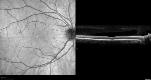 Normal Spectral Domain Optical Coherence Tomography (SD-OCT)
48-year-old woman has had a problem with light and dark adaptations.  She notices when she sees a point source of light like a cell phone in a dimly lit room and then she turns the cell phone off, that subsequently her vision is very dark until she goes back into a well lighted area.  OD 20/20,  OS 20/25. 
