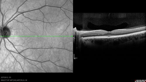Normal Spectral Domain Optical Coherence Tomography (SD-OCT)
48-year-old woman has had a problem with light and dark adaptations.  She notices when she sees a point source of light like a cell phone in a dimly lit room and then she turns the cell phone off, that subsequently her vision is very dark until she goes back into a well lighted area.  OD 20/20,  OS 20/25. 
