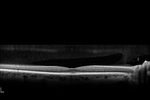 Normal Spectral Domain Optical Coherence Tomography (SD-OCT) - Prefoveal Vitreous Liquifaction
48-year-old woman has had a problem with light and dark adaptations.  She notices when she sees a point source of light like a cell phone in a dimly lit room and then she turns the cell phone off, that subsequently her vision is very dark until she goes back into a well lighted area.  OD 20/20,  OS 20/25. 
