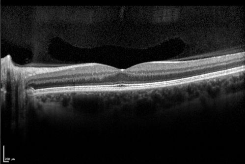 Normal Spectral Domain Optical Coherence Tomography (SD-OCT)
48-year-old woman has had a problem with light and dark adaptations.  She notices when she sees a point source of light like a cell phone in a dimly lit room and then she turns the cell phone off, that subsequently her vision is very dark until she goes back into a well lighted area.  OD 20/20,  OS 20/25. 
