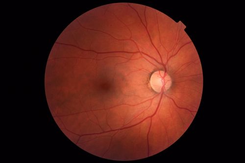 Choroidal Nevus - Macula - Flat
37 year old female with 5 year stable nevus Left eye - OCT shows flat nevus (EDI scan)
