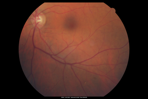 Normal Fellow Eye
65-year-old woman has pseudoretinitis pigmentosa in the right eye only, most likely from acute zonal occult outer retinopathy.   OD 20/25,  OS 20/25
