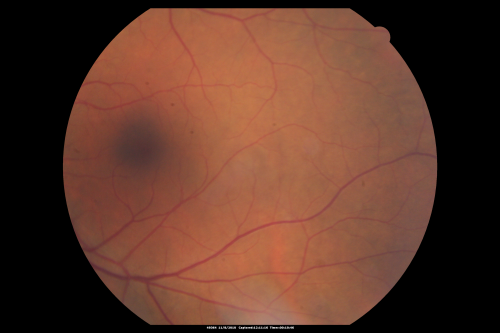 Normal Fellow Eye
65-year-old woman has pseudoretinitis pigmentosa in the right eye only, most likely from acute zonal occult outer retinopathy.   OD 20/25,  OS 20/25
