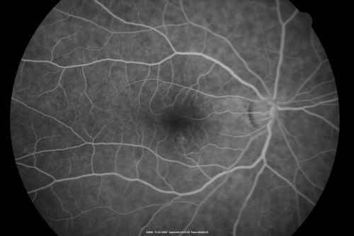 69 Year Old Woman Normal Fluorescein Angiogram
69-year-old woman   OD 20/50 - OS  20/30	ATYPICAL PHOTOPSIAS

