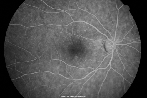 69 Year Old Woman Normal Fluorescein Angiogram
69-year-old woman   OD 20/50 - OS  20/30	ATYPICAL PHOTOPSIAS

