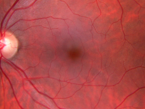 69 Year Old Woman Normal Fundus Photograph
69-year-old woman   OD 20/50 - OS  20/30	ATYPICAL PHOTOPSIAS

