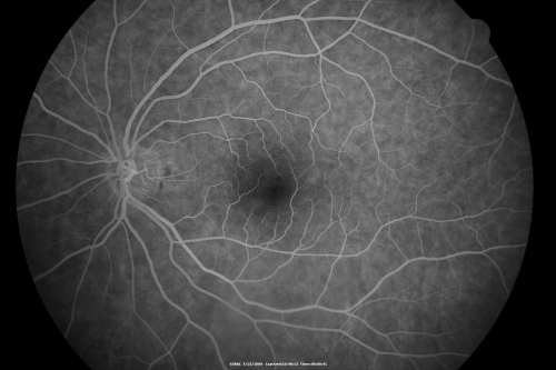69 Year Old Woman Normal fA
69-year-old woman   OD 20/50 - OS  20/30	ATYPICAL PHOTOPSIAS

