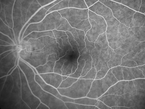 69 Year Old Woman Normal FA
69-year-old woman   OD 20/50 - OS  20/30	ATYPICAL PHOTOPSIAS

