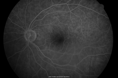 69 Year Old Woman Normal FA
69-year-old woman   OD 20/50 - OS  20/30	ATYPICAL PHOTOPSIAS


