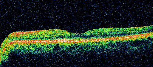 69 Year Old Woman Normal OCT
69-year-old woman   OD 20/50 - OS  20/30	ATYPICAL PHOTOPSIAS

