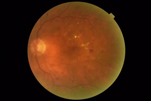 Diabetic Macular Edema with Exudates
Patient did not want injection therapy and did well with laser
