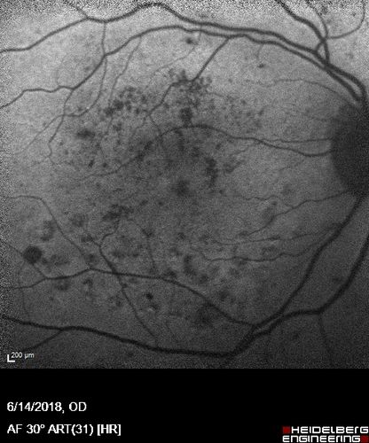 Diabetic Macular Edema with Exudates
Patient did not want injection therapy and did well with laser
