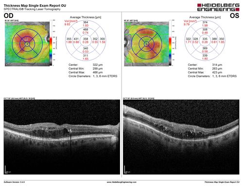 Diabetic Macular Edema with Exudates
Patient did not want injection therapy and did well with laser
