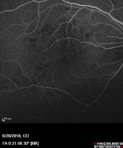 Diabetic Macular Edema with Exudates
Patient did not want injection therapy and did well with laser
