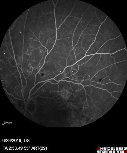 Diabetic Macular Edema with Exudates
Patient did not want injection therapy and did well with laser
