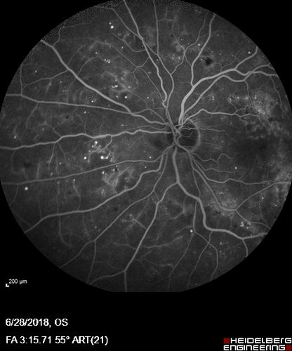 Diabetic Macular Edema with Exudates
Patient did not want injection therapy and did well with laser
