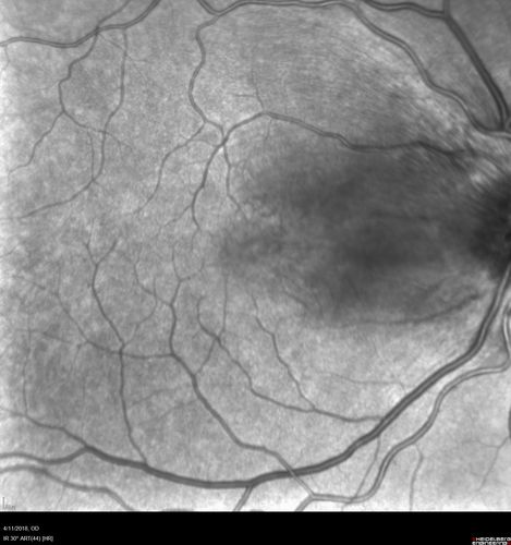 Neuroretinitis - Negative cat scratch serology twice - Possible Behcets
65 year old man with no direct cat exposure and vision loss from neuroretinitis.  His work up was positive for HLA B51.  He had negative cat scratch titers twice.  Vision dropped from 20/60 - 20/200 and then improved to 20/40 over 2 months
