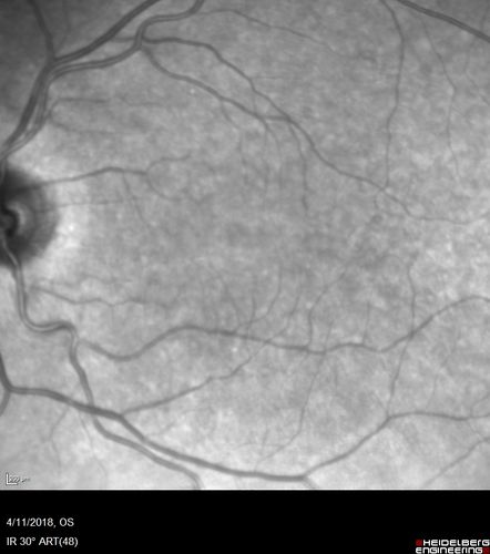 Neuroretinitis - Negative cat scratch serology twice - Possible Behcets
65 year old man with no direct cat exposure and vision loss from neuroretinitis.  His work up was positive for HLA B51.  He had negative cat scratch titers twice.  Vision dropped from 20/60 - 20/200 and then improved to 20/40 over 2 months

