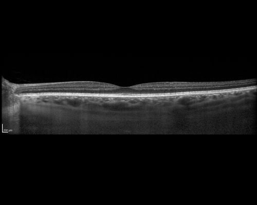 Neuroretinitis - Negative cat scratch serology twice - Possible Behcets
65 year old man with no direct cat exposure and vision loss from neuroretinitis.  His work up was positive for HLA B51.  He had negative cat scratch titers twice.  Vision dropped from 20/60 - 20/200 and then improved to 20/40 over 2 months
