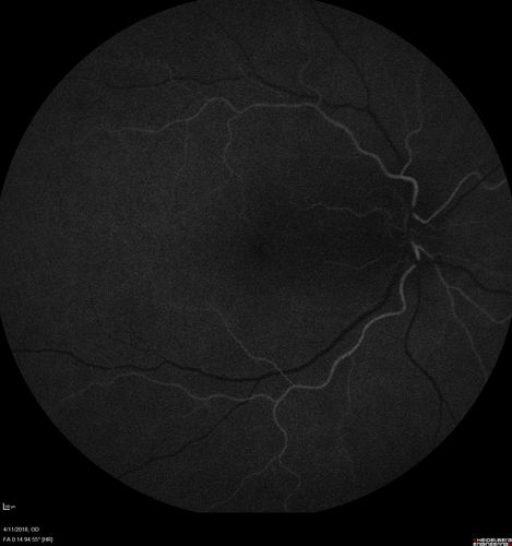 Neuroretinitis - Negative cat scratch serology twice - Possible Behcets
65 year old man with no direct cat exposure and vision loss from neuroretinitis.  His work up was positive for HLA B51.  He had negative cat scratch titers twice.  Vision dropped from 20/60 - 20/200 and then improved to 20/40 over 2 months
