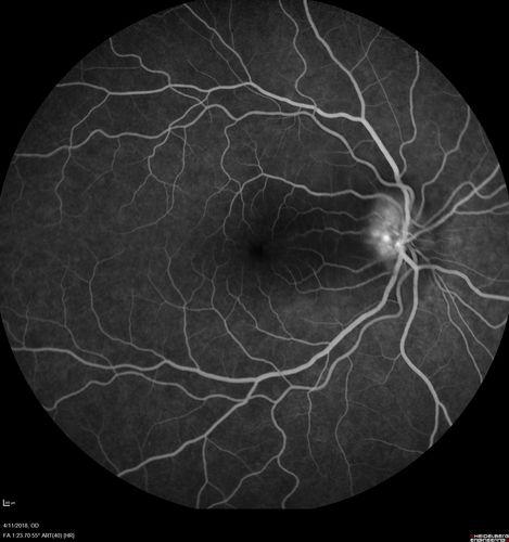 Neuroretinitis - Negative cat scratch serology twice - Possible Behcets
65 year old man with no direct cat exposure and vision loss from neuroretinitis.  His work up was positive for HLA B51.  He had negative cat scratch titers twice.  Vision dropped from 20/60 - 20/200 and then improved to 20/40 over 2 months

