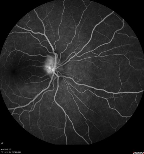 Neuroretinitis - Negative cat scratch serology twice - Possible Behcets
65 year old man with no direct cat exposure and vision loss from neuroretinitis.  His work up was positive for HLA B51.  He had negative cat scratch titers twice.  Vision dropped from 20/60 - 20/200 and then improved to 20/40 over 2 months
