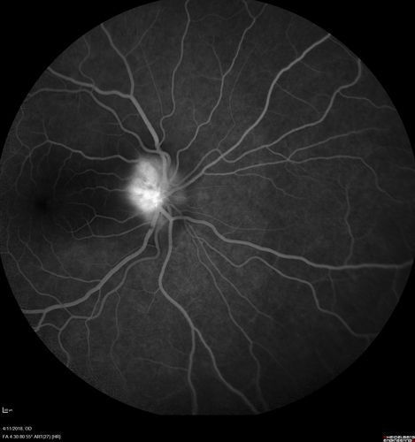Neuroretinitis - Negative cat scratch serology twice - Possible Behcets
65 year old man with no direct cat exposure and vision loss from neuroretinitis.  His work up was positive for HLA B51.  He had negative cat scratch titers twice.  Vision dropped from 20/60 - 20/200 and then improved to 20/40 over 2 months
