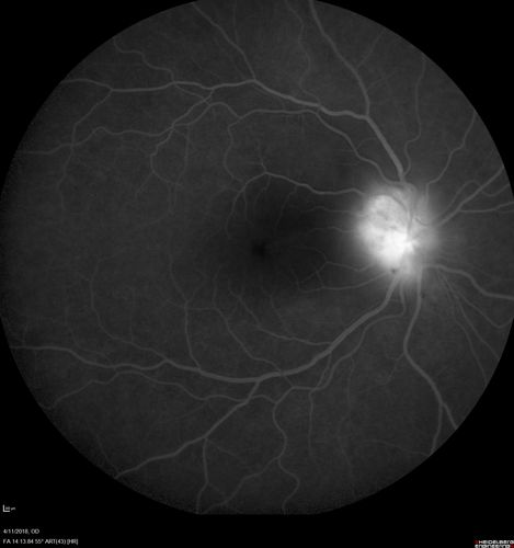 Neuroretinitis - Negative cat scratch serology twice - Possible Behcets
65 year old man with no direct cat exposure and vision loss from neuroretinitis.  His work up was positive for HLA B51.  He had negative cat scratch titers twice.  Vision dropped from 20/60 - 20/200 and then improved to 20/40 over 2 months
