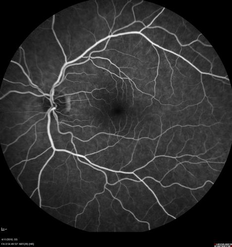 Neuroretinitis - Negative cat scratch serology twice - Possible Behcets
65 year old man with no direct cat exposure and vision loss from neuroretinitis.  His work up was positive for HLA B51.  He had negative cat scratch titers twice.  Vision dropped from 20/60 - 20/200 and then improved to 20/40 over 2 months
