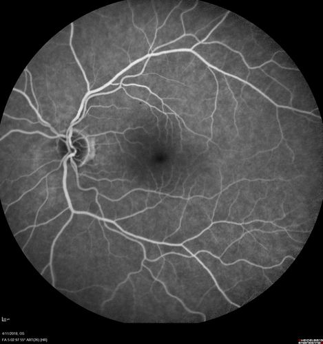 Neuroretinitis - Negative cat scratch serology twice - Possible Behcets
65 year old man with no direct cat exposure and vision loss from neuroretinitis.  His work up was positive for HLA B51.  He had negative cat scratch titers twice.  Vision dropped from 20/60 - 20/200 and then improved to 20/40 over 2 months
