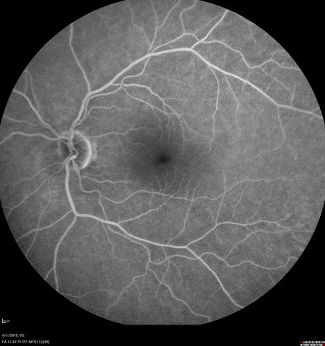 Neuroretinitis - Negative cat scratch serology twice - Possible Behcets
65 year old man with no direct cat exposure and vision loss from neuroretinitis.  His work up was positive for HLA B51.  He had negative cat scratch titers twice.  Vision dropped from 20/60 - 20/200 and then improved to 20/40 over 2 months
