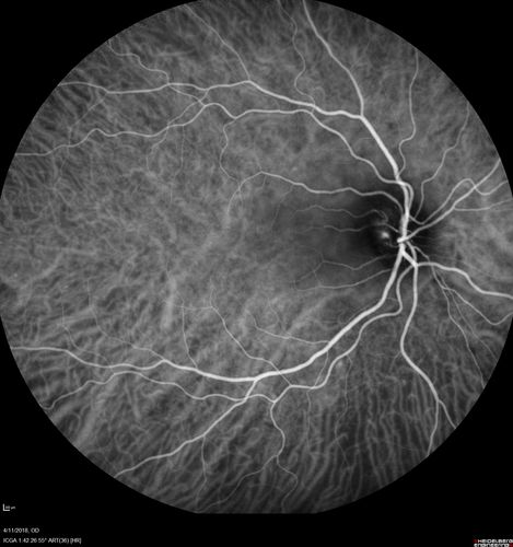 Neuroretinitis - Negative cat scratch serology twice - Possible Behcets
65 year old man with no direct cat exposure and vision loss from neuroretinitis.  His work up was positive for HLA B51.  He had negative cat scratch titers twice.  Vision dropped from 20/60 - 20/200 and then improved to 20/40 over 2 months
