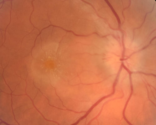 Neuroretinitis - Negative cat scratch serology twice - Possible Behcets
65 year old man with no direct cat exposure and vision loss from neuroretinitis.  His work up was positive for HLA B51.  He had negative cat scratch titers twice.  Vision dropped from 20/60 - 20/200 and then improved to 20/40 over 2 months
