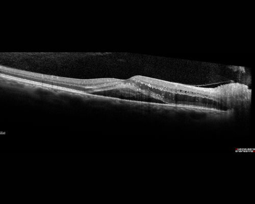 Neuroretinitis - Negative cat scratch serology twice - Possible Behcets
65 year old man with no direct cat exposure and vision loss from neuroretinitis.  His work up was positive for HLA B51.  He had negative cat scratch titers twice.  Vision dropped from 20/60 - 20/200 and then improved to 20/40 over 2 months
