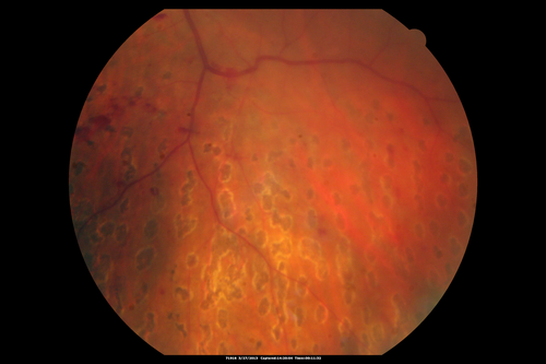 Proliferative Diabetic Retinopathy - Fresh and Old Scatter (Panretinal) Photocoagulation (Laser) - Neovascularization is regressing
1 month after initial laser
