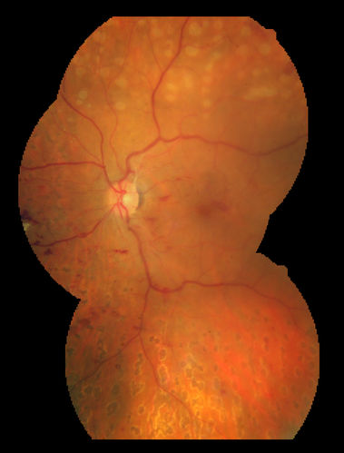 Proliferative Diabetic Retinopathy - Fresh and Old Scatter (Panretinal) Photocoagulation (Laser) - Neovascularization is regressing
1 month after initial laser
