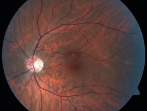 Occult Maculopathy - Thin Fovea on OCT and Normal Color VA, Photos, FA VA 20/80 OU
45-year-old man his mother and his maternal grandmother each had vision loss at a relatively young age.  Retina OS normal
Keywords: occult maculopathy;foveal atrophy